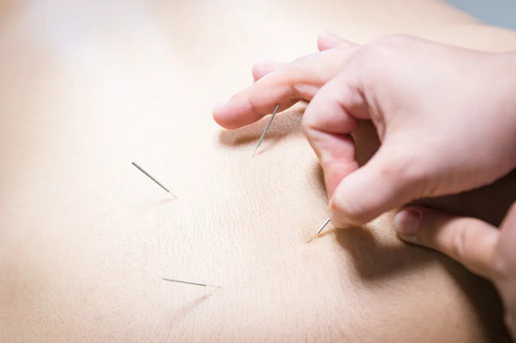 Dry Needling i Trollhättan, Uddevalla, Ljungskile